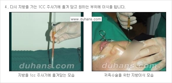 ​​​⁠[두한성형외과 경쟁력 미세지방이식] - [귀족수술 - 입체미세지방이식 ②] 관련 이미지 6