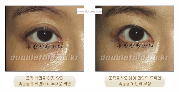 [두한성형외과 경쟁력 눈성형] - [쌍꺼풀 재수술 실패의 원인과 문제점] 관련 이미지 3