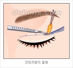 [두한성형외과 경쟁력 눈성형 리더] - [아름다운 눈매를 위한 쌍꺼풀 수술 안내] 관련 이미지 8