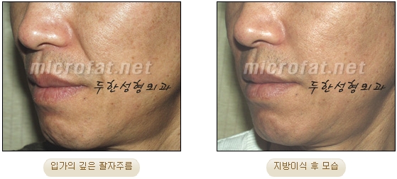Wrinkle Improvement, Duhan Plastic Surgery - Mouth Lines, Nasolabial Folds image 17