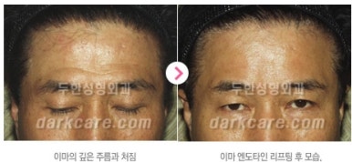 [눈밑수술 두한성형외과] - [다크서클 콤비프로그램] 관련 이미지 146