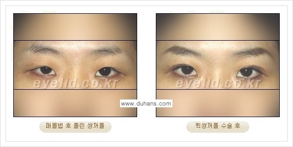 [두한성형외과 경쟁력 눈성형] - [퀵쌍꺼풀 - 부분절개법] 관련 이미지 4