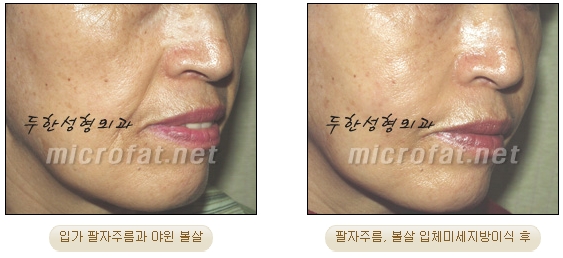 Fat Grafting Leader Duhan Plastic Surgery - Everything About Fat Grafting image 15