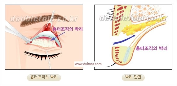 [두한성형외과 경쟁력 쌍꺼풀 재수술] - [쌍꺼풀 재수술 과정] 관련 이미지 62