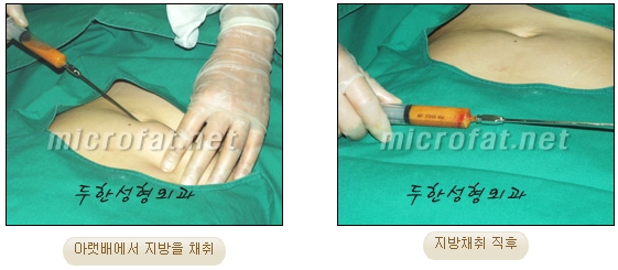 [두한성형외과 지방이식] - [다크서클, 눈밑주름] 관련 이미지 8