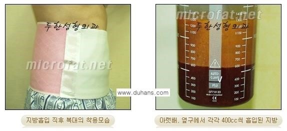 [두한성형외과 경쟁력 바디성형] - [아랫배, 윗배, 옆구리살, 허리살, 팔뚝살 지방흡입] 관련 이미지 9