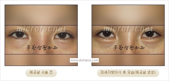 [두한성형외과 경쟁력 눈밑성형] - [타 병원 필러 애교살 시술 부작용을 미세지방이식으로 교정] 관련 이미지 16