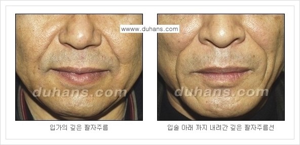 ​[두한성형외과 경쟁력 주름성형] - [주름교정을 위한 미세지방이식 안내 1.] 관련 이미지 5