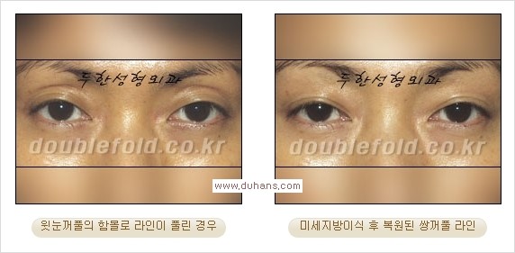 [두한성형외과 경쟁력 쌍꺼풀 재수술, 극한 눈재수술] - [미세지방이식으로 쌍꺼풀 라인의 복원에 관한 질문과 답변] 관련 이미지 4