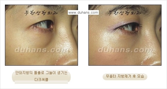 [두한성형외과 젊은 눈매 안검성형] - [눈밑 지방제거의 수술 전후 안내 ①] 관련 이미지 17