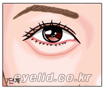 [두한성형외과 지방제거] - [눈두덩이지방제거, 눈밑지방제거] 관련 이미지 14