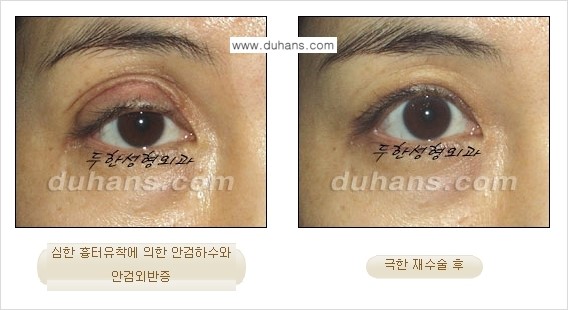 [두한성형외과 성형 FOCUS] - [정상적인 눈매로의 복원 극한재수술 경우 ②] 관련 이미지 6