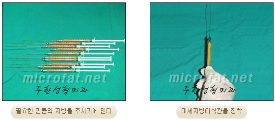 [Duhan Plastic Surgery Lip Surgery] - [Lip Correction Fat Grafting] image 6