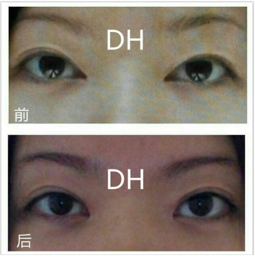[Duhan Plastic Surgery Eyelid Surgery] - [Epicanthoplasty, Medial Canthoplasty] image 25