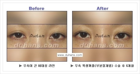 [두한성형외과 경쟁력 쌍꺼풀 재수술, 극한 재수술] - [퀵쌍꺼풀 안내] 관련 이미지 10