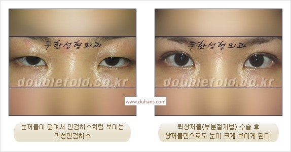 ⁠⁠[두한성형외과 경﻿쟁력 쌍꺼풀 재수술] - [안검하수(졸리운 눈매) 종류와 교정 방법 안내] 관련 이미지 20