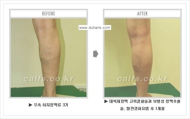 [두한성형외과 경쟁력 멀티종아리성형] - [하지정맥류 치료 안내] 관련 이미지 6