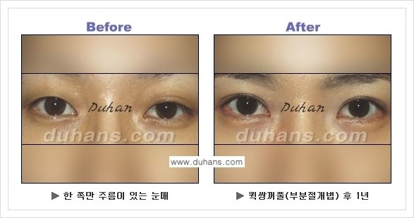 [두한성형외과 경쟁력 눈성형] - [퀵쌍꺼풀 수술 전후 정보 안내 ①] 관련 이미지 1