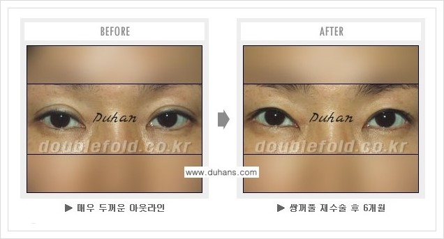 [두한성형외과 경쟁력 쌍꺼풀(눈) 재수술] - [쌍꺼풀 재수술시 잘못된 수술로 인한 넓어진 흉터 처리 안내] 관련 이미지 3