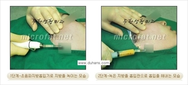 [두한성형외과 경쟁력 지방흡입] - [얼굴, 볼살, 턱살, 턱선의 초음파 지방흡입] 관련 이미지 9