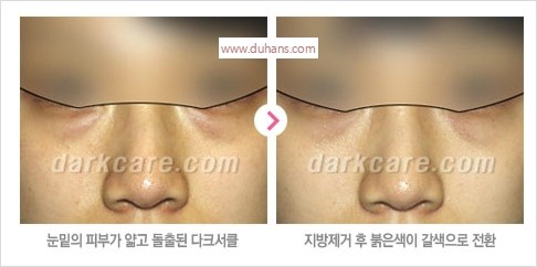 [두한성형외과 경쟁력 눈밑성형] - [하안검성형(눈밑주름제거술)과 눈밑지방재배치안내] 관련 이미지 16