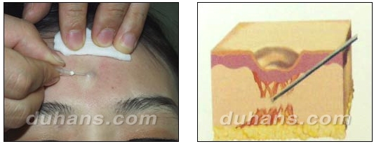 [DuHan Plastic Surgery Scar] - [DHL Simple Scar Treatment] image 4