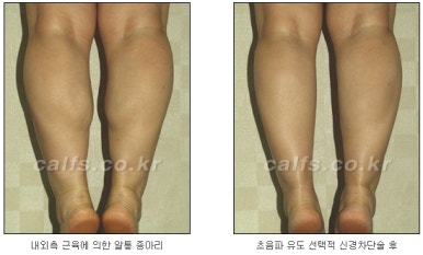 [두한성형외과 종아리수술] - [종아리성형 실패의 원인] 관련 이미지 3