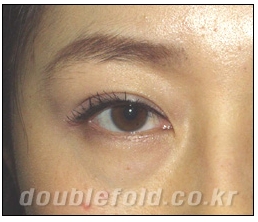 [Dohan Plastic Surgery Double Eyelid Surgery] - [Beautiful Double Eyelids] image 5
