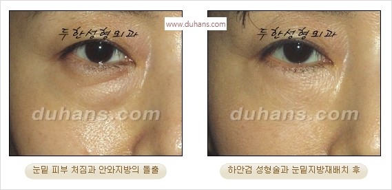 [두한성형외과 경쟁력 안검성형] - [젊어 보이면서 개선된 인상을 주기 위한 성형] 관련 이미지 35