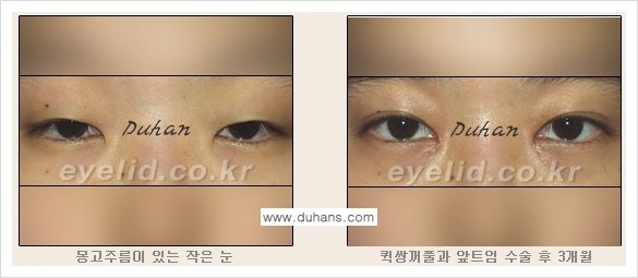 [두한성형외과 FOCUS 눈성형] - [퀵쌍꺼풀에 대한 질문과 답변들] 관련 이미지 4