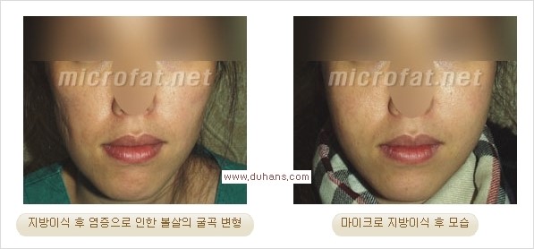 ​[두한성형외과 경쟁력 지방이식] - [지방이식 부작용 이후 마이크로 지방흡입, 마이크로 지방흡입 이후 부작용 없는 지방이식 방법] 관련 이미지 18