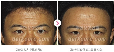 Duhan Plastic Surgery Combo Program - Dark Circles and Lifting image 26