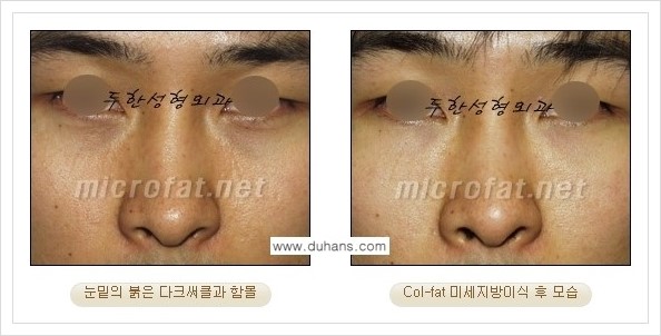 [두한성형외과 경쟁력 눈밑성형] - [눈밑 다크써클과 눈밑 함몰주름의 최적화 교정방법 안내] 관련 이미지 18