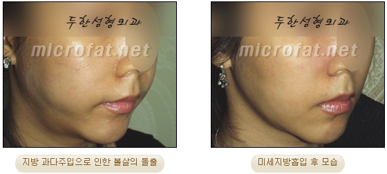 [두한성형외과 지방이식] - [타병원의 지방이식 부작용 교정] 관련 이미지 26