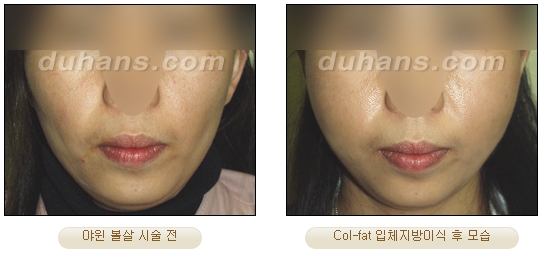 [Duhan Plastic Surgery Facial Autologous Fat Grafting] - [Fat Grafting Guide] image 30