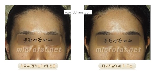 [두한성형외과 경쟁력 미세지방이식] - [관자놀이(측두부) 지방이식] 관련 이미지 11