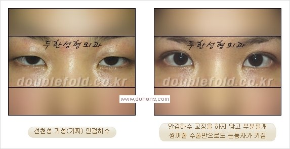 [두한성형외과 경쟁력 눈성형] - [안검하수(졸린눈매) 눈매교정 여러 가지 방법 안내] 관련 이미지 3