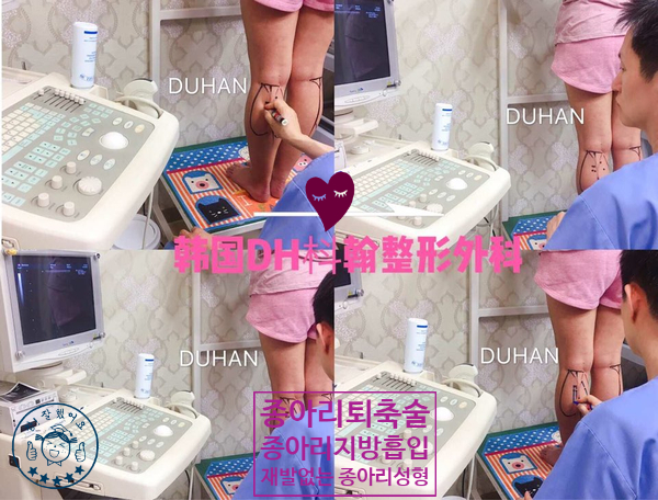 [Duhan Plastic Surgery Clinic Calf Recession Surgery] - [Calf Muscle Surgery] image 32