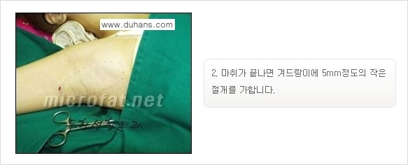 [두한성형외과 경쟁력 액취증, 다한증 치료] - [겨드랑이의 참기 힘든 냄새와 땀 치료 - 초음파 컷터지방흡입 + 리포셋 소파흡입술] 관련 이미지 15
