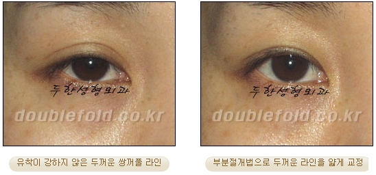 [두한성형외과 눈재수술] - [부분절개법 재수술] 관련 이미지 38