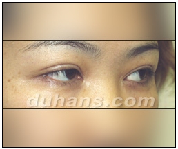 Candidates for Double Eyelid Revision Surgery: Unattractive Double Eyelids, Beautiful Double Eyelids image 16