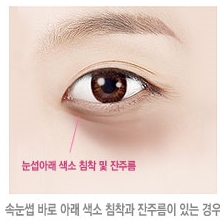 두한성형외과 눈밑수술 - 다크서클 수술 전후 관리 안내 관련 이미지 108