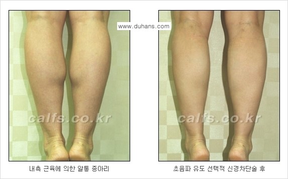 ​[두한성형외과와 날씬한 종아리 만들기!] - [간편하고 안전한 종아리 축소방법 ③] 관련 이미지 11