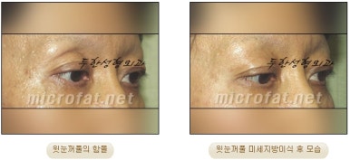 [Doohan Plastic Surgery Autologous Fat Grafting] - [Sunken Eye Fat Grafting] image 18