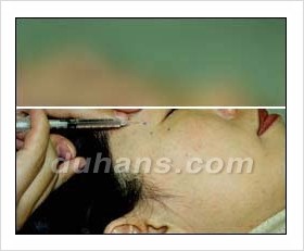 ​[두한성형외과 안티에이징] - [보톡스, 필러, 지방이식을 이용한 주름개선] 관련 이미지 4