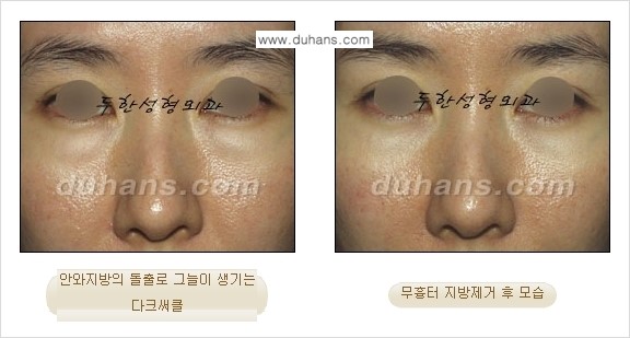 [두한성형외과 젊은 눈매 안검성형] - [눈밑 지방제거의 수술 전후 안내 ②] 관련 이미지 12