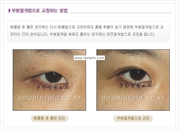 [두한성형외과 경쟁력 쌍꺼풀(눈) 재수술] - [풀린 쌍꺼풀 절개법으로 교정하는 방법 안내] 관련 이미지 5