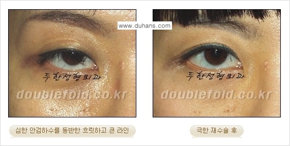 [두한성형외과 경쟁력 쌍꺼풀 재수술, 극한 눈재수술] - [망친 쌍꺼풀을 복원하는 극한 눈재수술] 관련 이미지 8