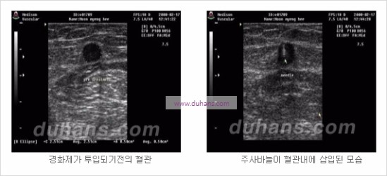 [두한성형외과 경쟁력 정맥류 치료] - [정맥류 치료의 모든 것] 관련 이미지 11