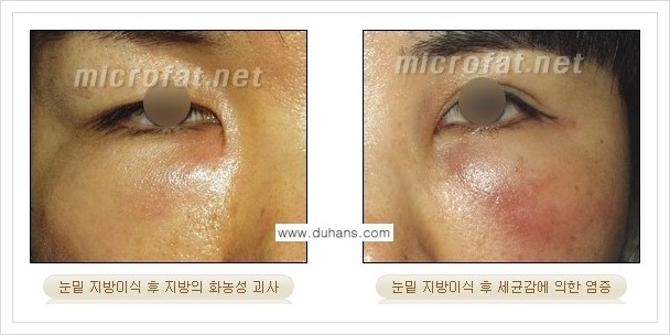 ⁠[두한성형외과 경쟁력 미세지방이식] - [미세지방이식의 부작용 문제 교정 안내] 관련 이미지 10